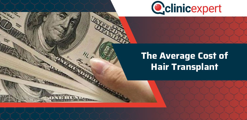 The Average Cost of Hair Transplant