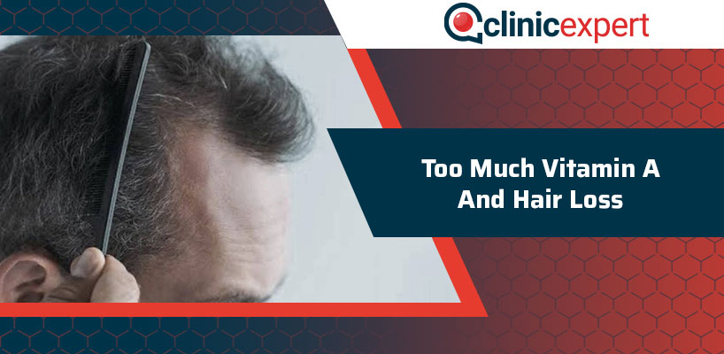 Too Much Vitamin A And Hair Loss | ClinicExpert
