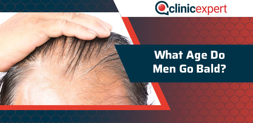 What Age Do Men Go Bald?