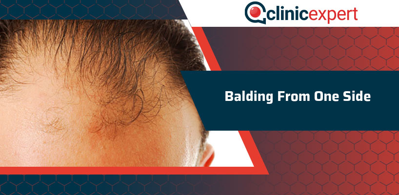 Balding From One Side