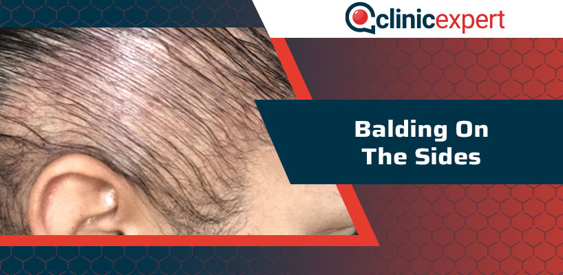 Balding On The Sides