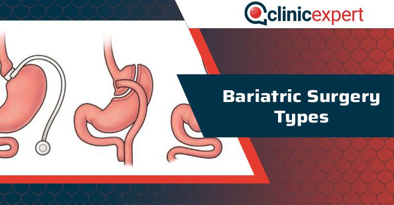 Bariatric Surgery Types