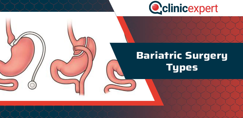 Bariatric Surgery Types