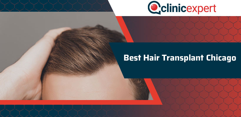 Best Hair Transplant Chicago