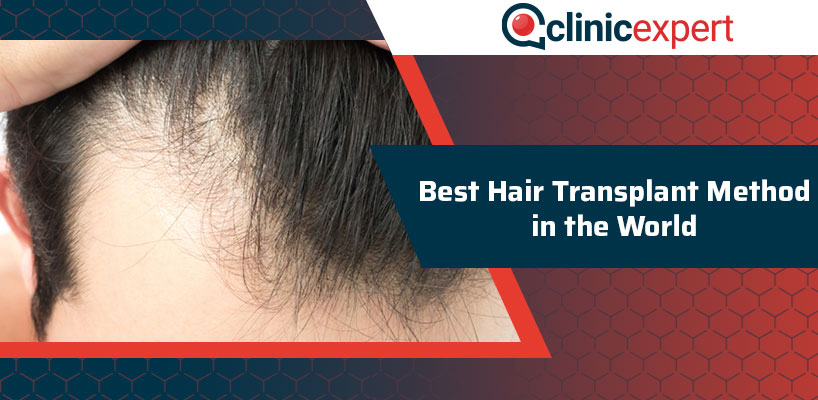 Best Hair Transplant Method In The World | ClinicExpert