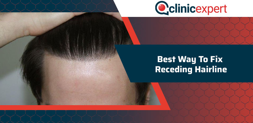 Best Way To Fix Receding Hairline | ClinicExpert