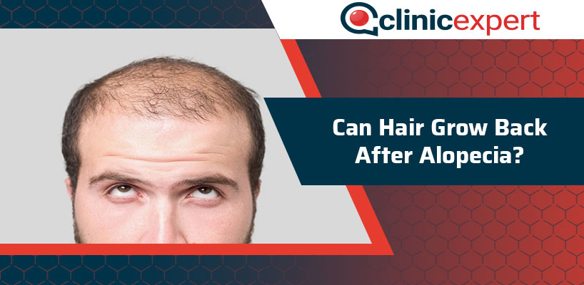 Can Hair Grow Back After Alopecia?