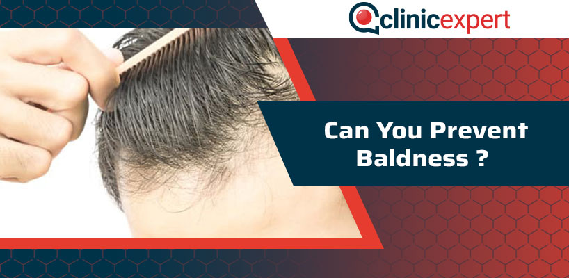 Can You Prevent Baldness?