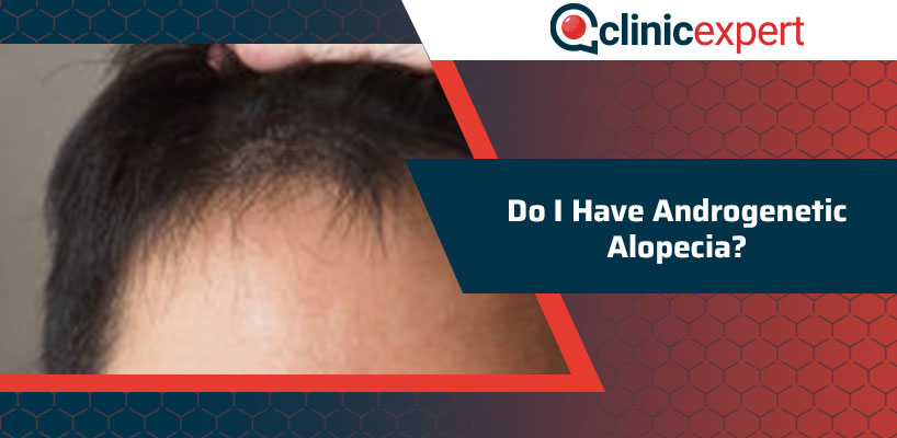 Do I have Androgenetic Alopecia?