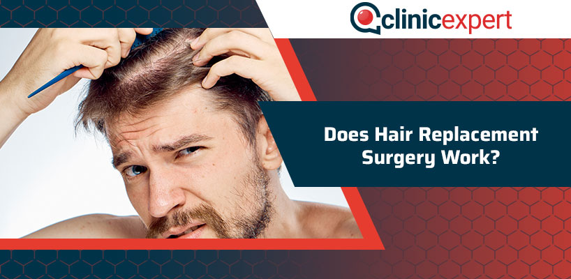 Does Hair Replacement Surgery Work?