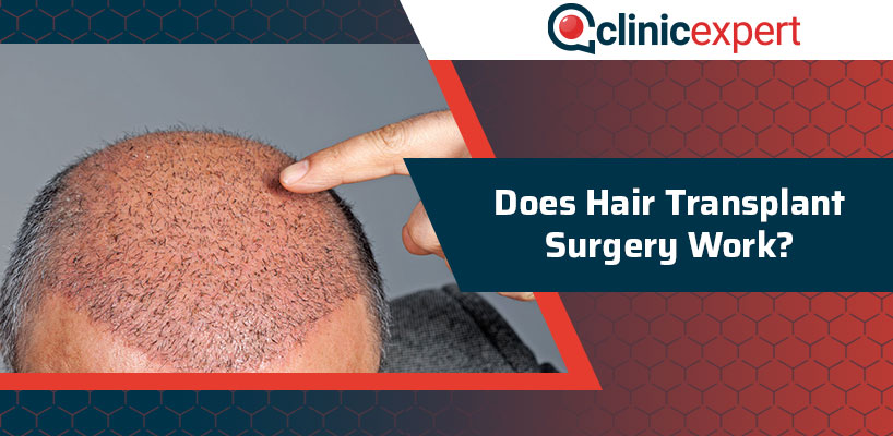 Does Hair Transplant Surgery Work?