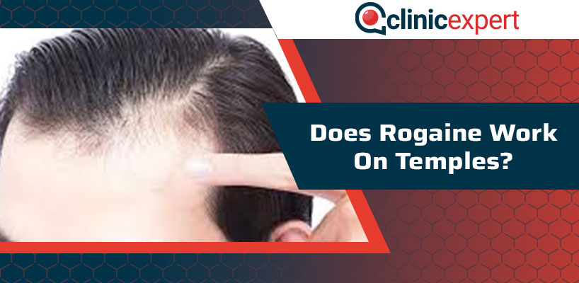 Does Rogaine Work On Temples? | ClinicExpert