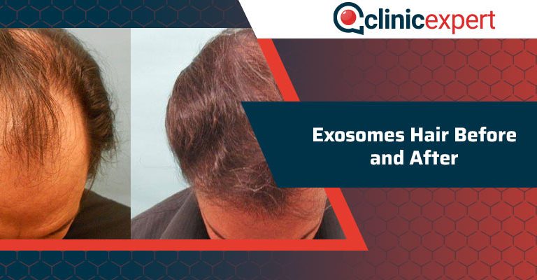 Exosomes Hair Before and After