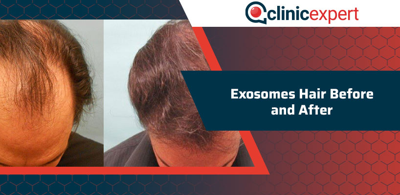 Exosomes Hair Before and After