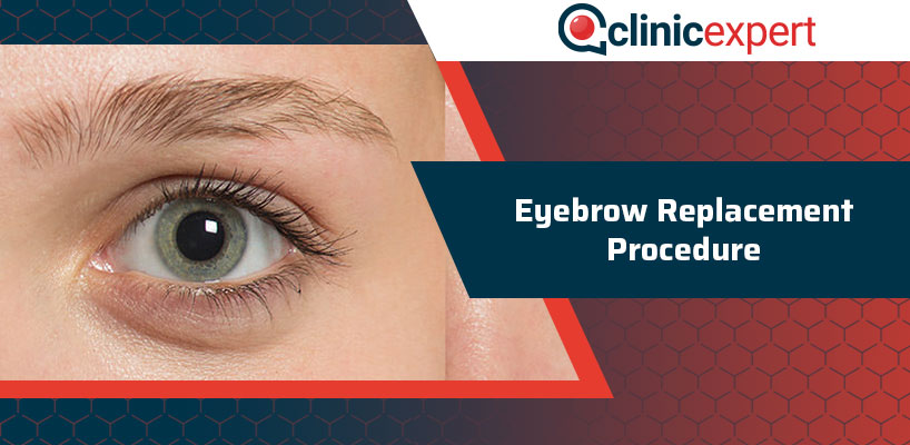 Eyebrow Replacement Procedure