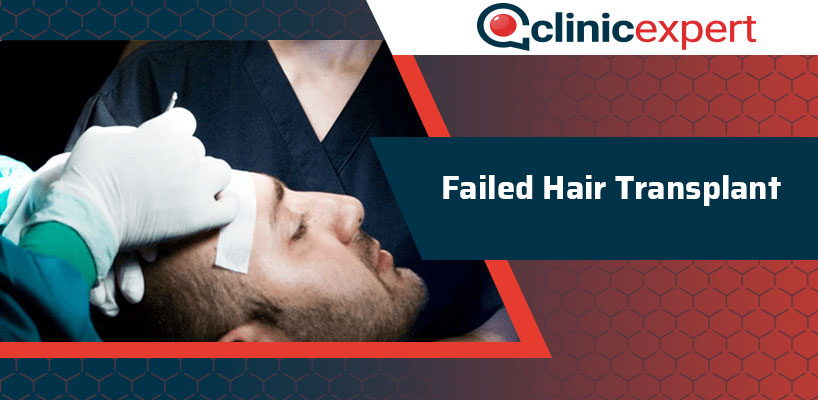 Failed Hair Transplant