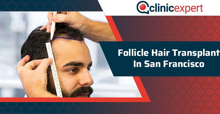 Follicle Hair Transplant In San Francisco