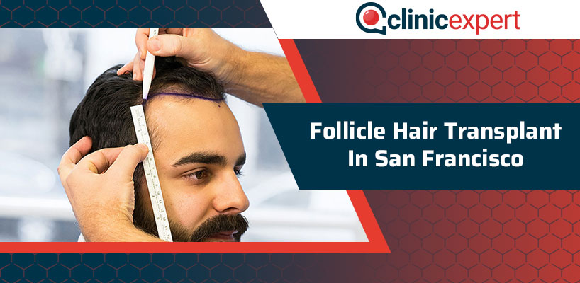 Follicle Hair Transplant In San Francisco