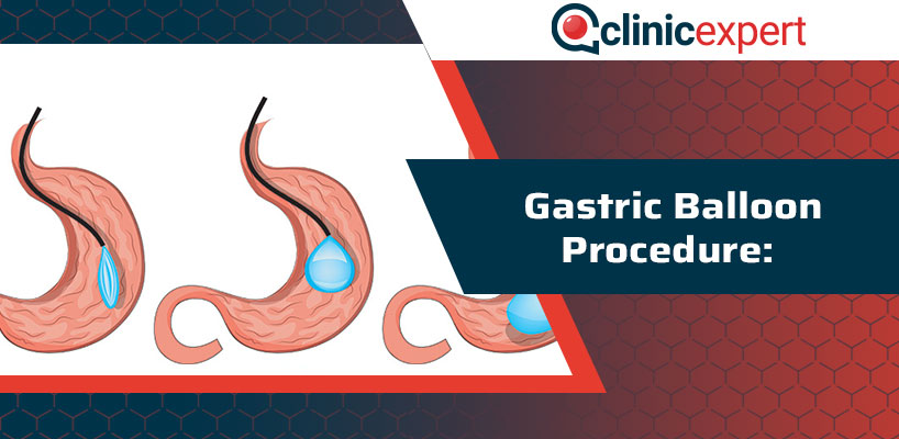 Gastric Balloon Procedure