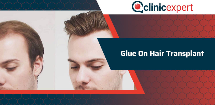 Glue On Hair Transplant