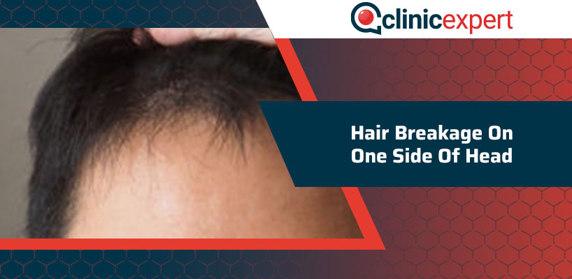 Hair Breakage On One Side Of Head