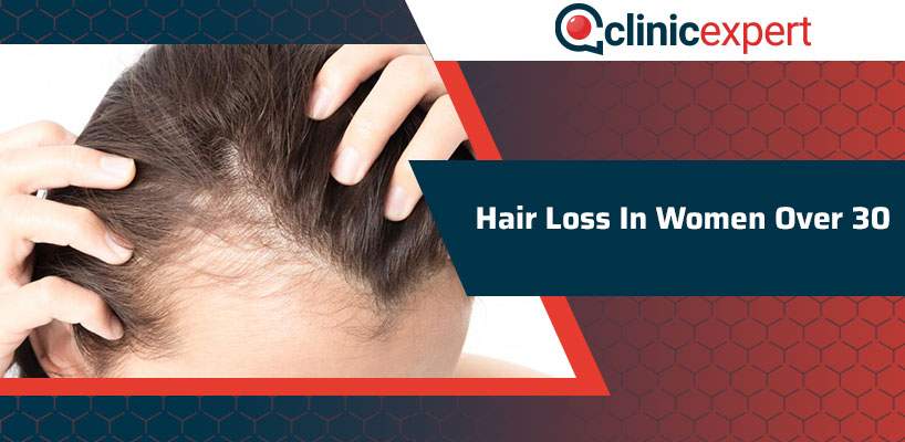 Hair loss In Women Over 30