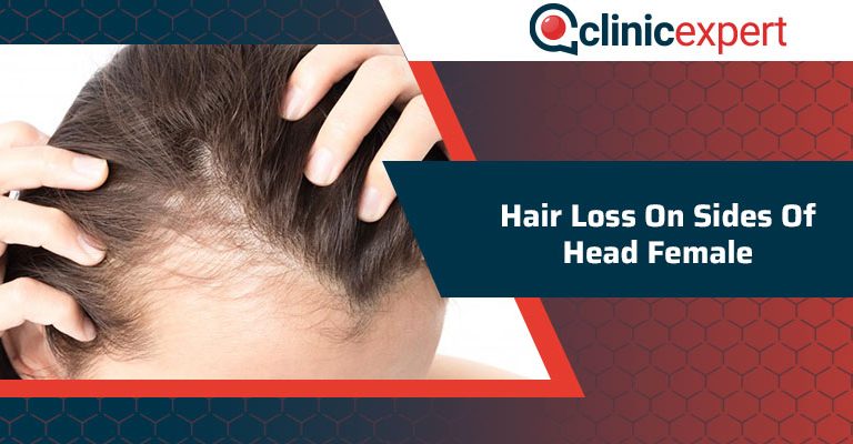 Hair Loss On Sides Of Head Female