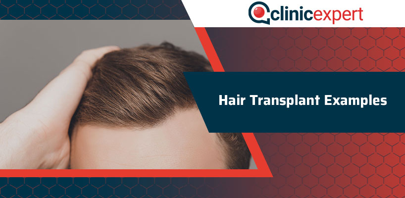 Hair Transplant Examples