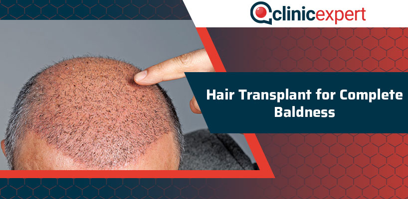 Hair Transplant For Complete Baldness