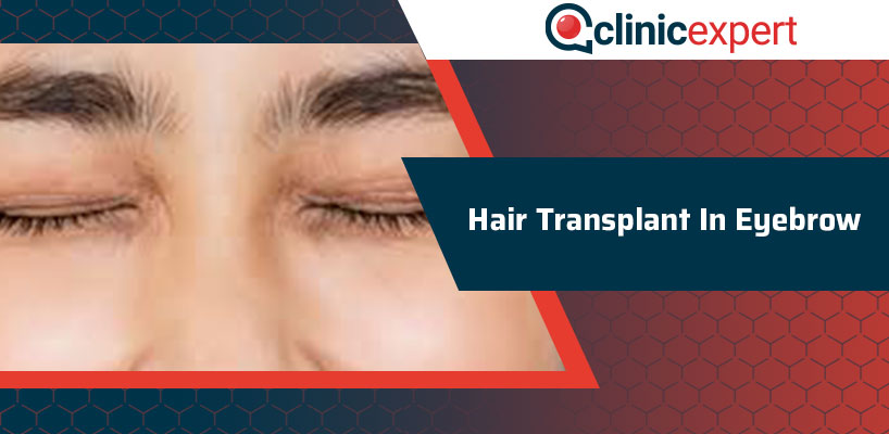 Hair Transplant In Eyebrow