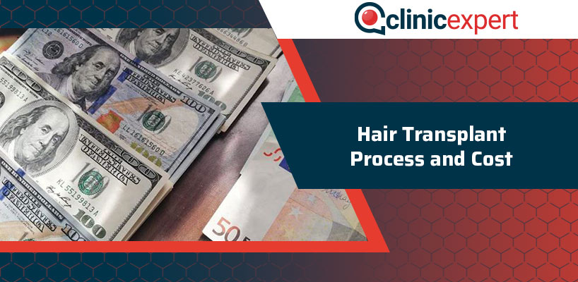 Hair Transplant Process and Cost