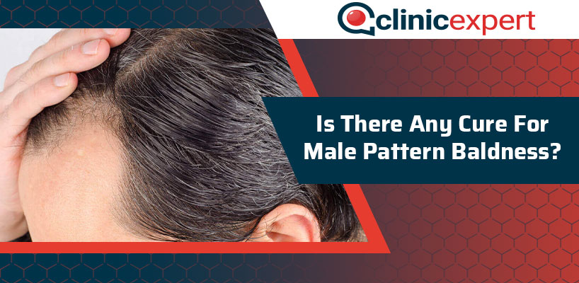 Is There Any Cure For Male Pattern Baldness?