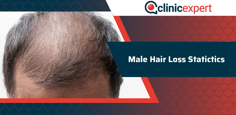 Male Hair Loss Statictics
