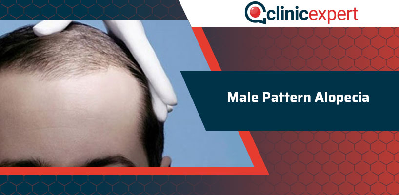 Male Pattern Alopecia