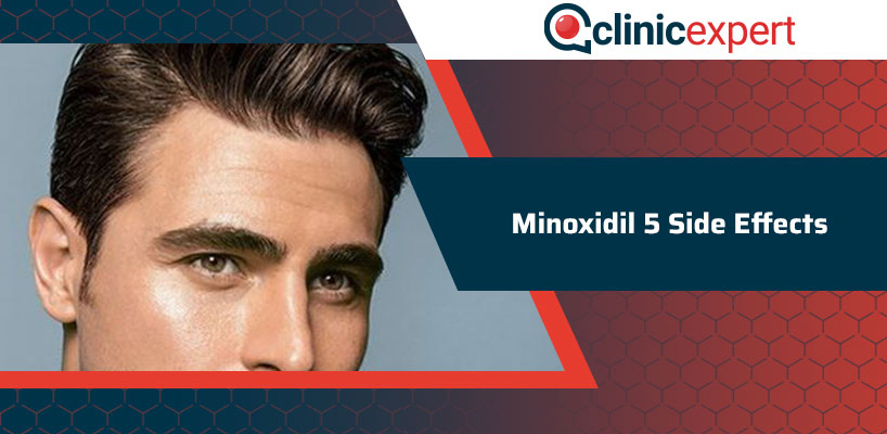 Minoxidil 5 Side Effects