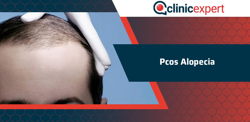 Pcos Alopecia 