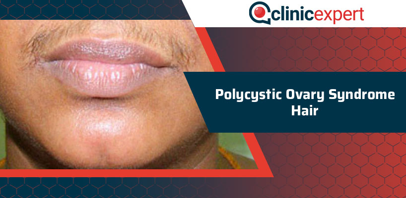 Polycystic Ovary Syndrome Hair