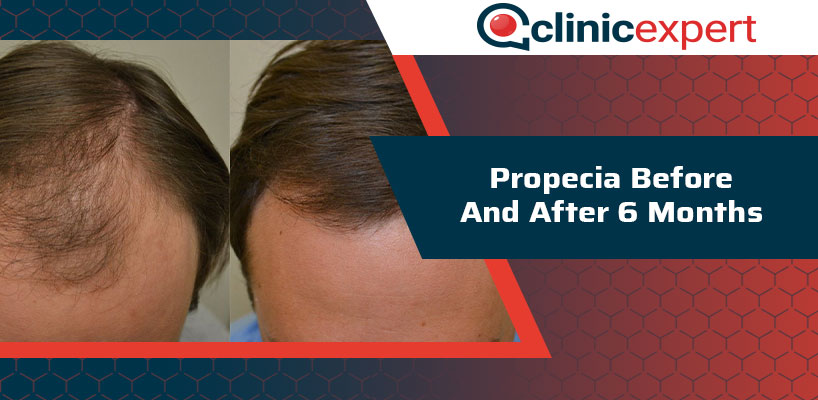 Propecia Before And After 6 Months | ClinicExpert