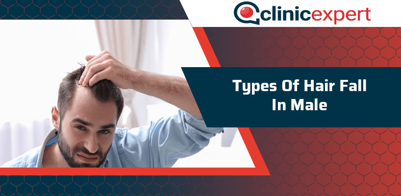 Types Of Hair Fall In Male | ClinicExpert