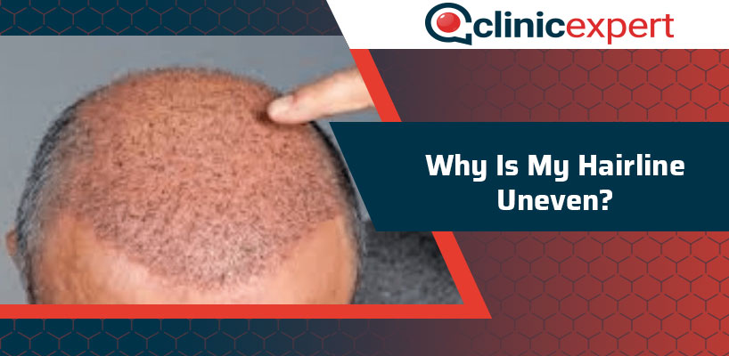 Why Is My Hairline Uneven? | ClinicExpert