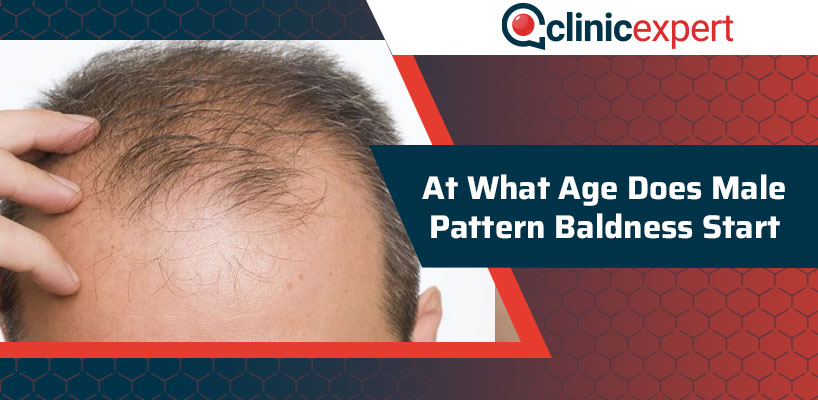 At What Age Does Male Pattern Baldness Start?