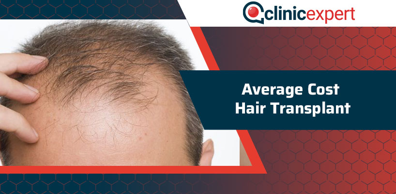 Best Hair Transplant In Istanbul, Turkey 2021- DrBayer Clinics