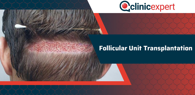 Follicular Unit Transplantation ClinicExpert