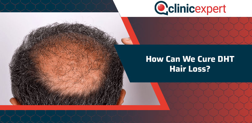 How Can We Cure Dht Hair Loss Clinicexpert