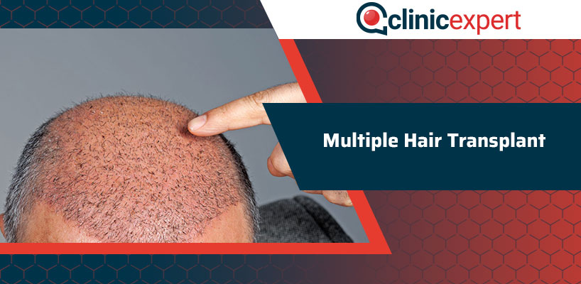 Multiple Hair Transplant 