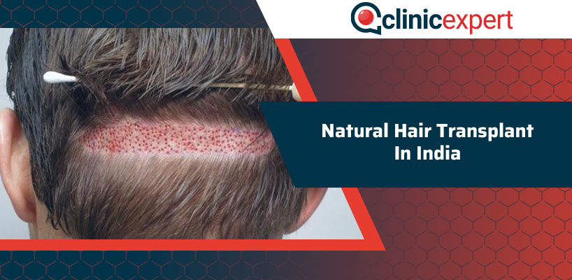 Natural Hair Transplant In India