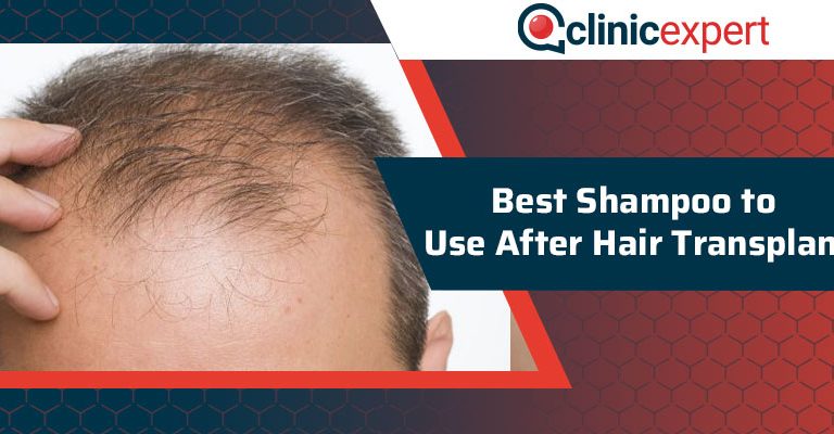 Best Shampoo to Use After Hair Transplant