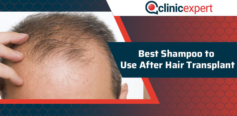 Best Shampoo to Use After Hair Transplant