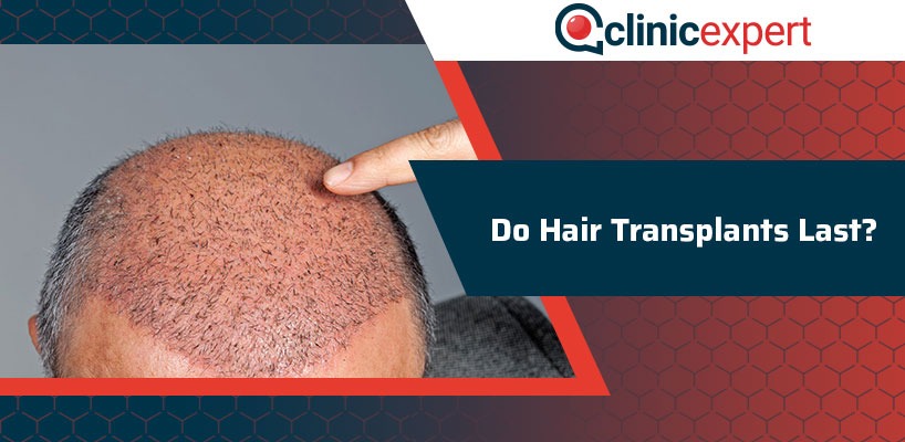 Do Hair Transplants Last?