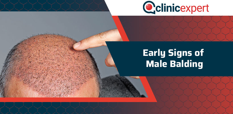 Early Signs of Male Balding
